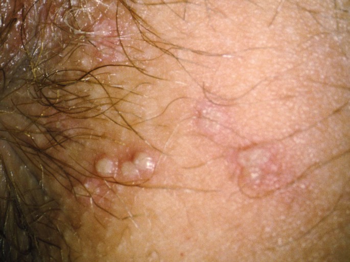 Herpes im genitalbereich frau