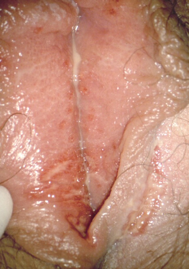 Scheide der zoster herpes in Herpes Zoster