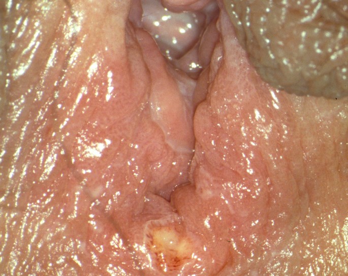 Herpes genitalis frau