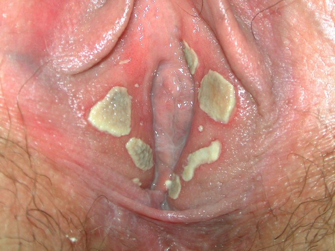 Der scheide herpes genitalis in 
