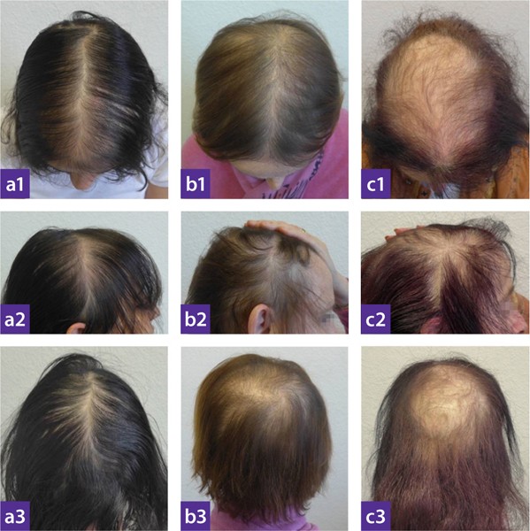 Alopecia androgenetica der Frau | SpringerLink