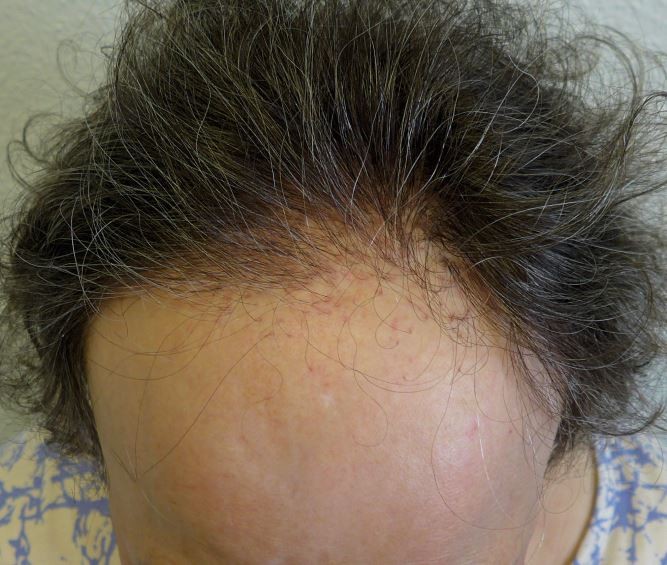 Vernarbende Alopezien bei Frauen | SpringerLink