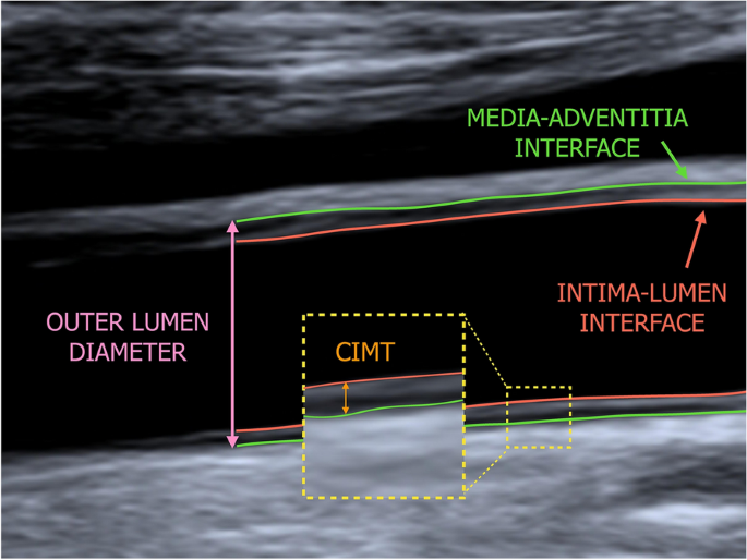Evaluation of Intima-Media Thickness and Arterial Stiffness as Early  Ultrasound Biomarkers of Carotid Artery Atherosclerosis | SpringerLink