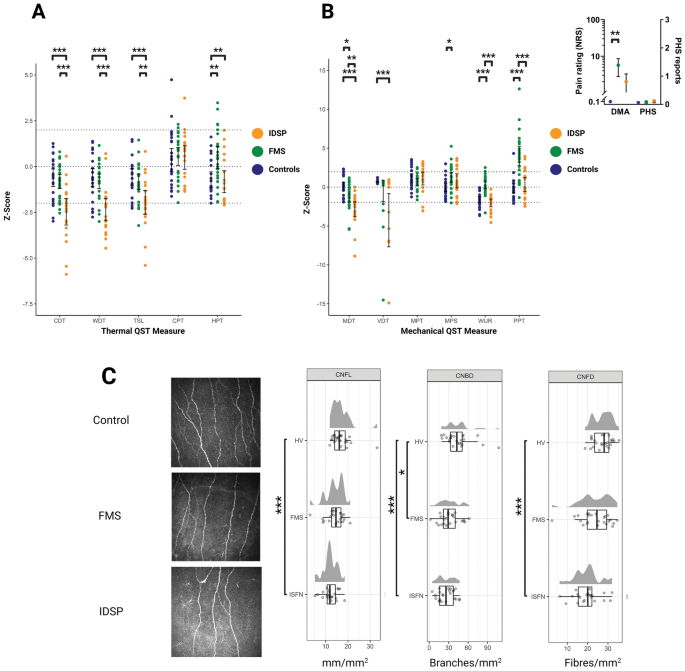 Idiopathic Distal Sensory Polyneuropathy and Fibromyalgia Syndrome A