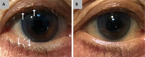 Demodex Blepharitis Treated with a Novel Dilute Povidone-Iodine and DMSO  System: A Case Report | Ophthalmology and Therapy