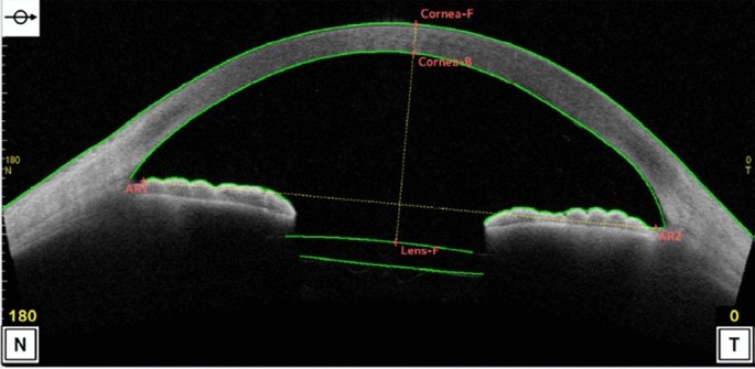 Relationship Between Postoperative Intraocular Lens Shift and 