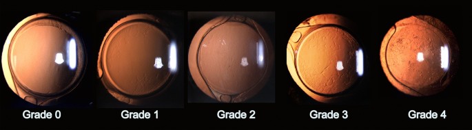 Early-Onset Posterior Capsule Opacification: Incidence, Severity, and Risk  Factors | SpringerLink