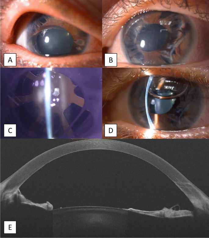Complications chart showing various eye color surgery risks