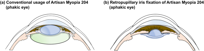 Retropupillary Iris Fixation of an Artisan Myopia Lens for Intraocular Lens  Dislocation and Aphakia in Eyes with Extremely High Myopia: A Case Series  and a Literature Review | SpringerLink