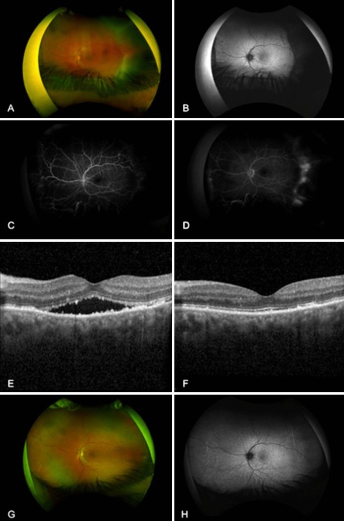 topomax choroidal effusion