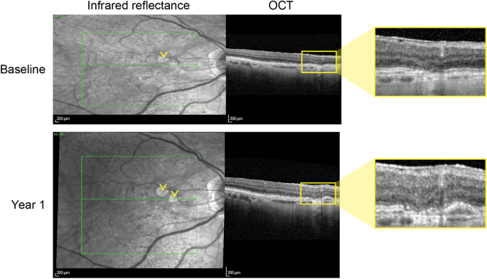Predict and Protect: Evaluating the Double-Layer Sign in Age-Related ...