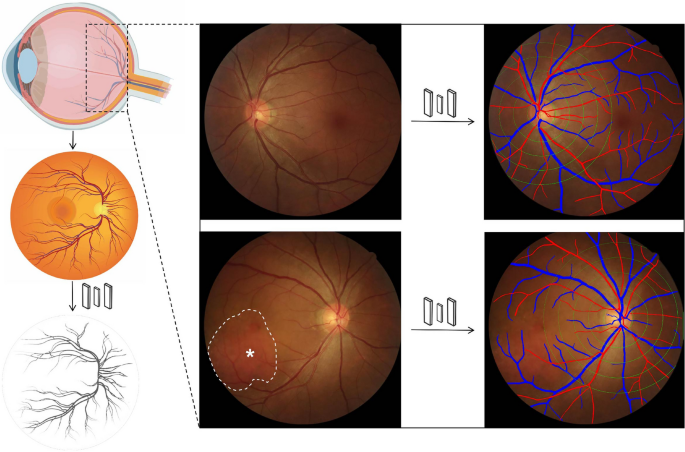 AI-Based Quantitative Assessment of Retinal Vascular Morphology in ...