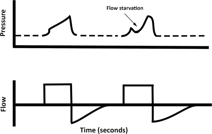 The Basics of Ventilator Waveforms | SpringerLink