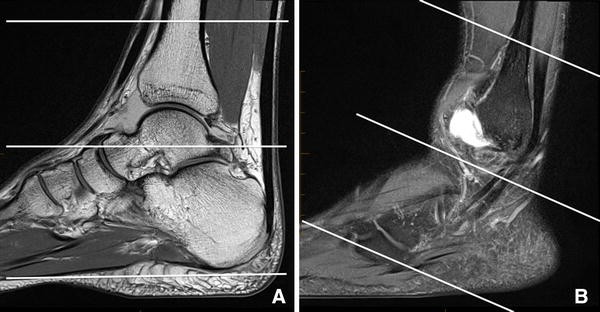 State Of The Art Mr Imaging Techniques For The Foot And Ankle Springerlink