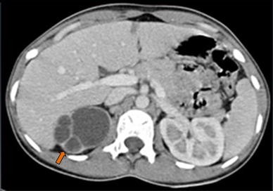 Multidetector CT in Renal Tuberculosis | SpringerLink