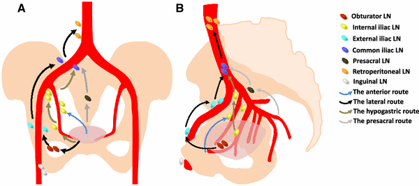 Imaging of Pelvic Lymph Nodes | SpringerLink