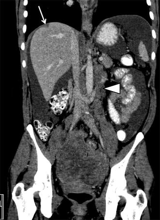 Update On Imaging Of Ovarian Cancer Springerlink