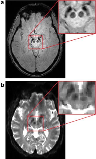 Imaging Parkinsonian Pathology In Substantia Nigra With Mri Springerlink