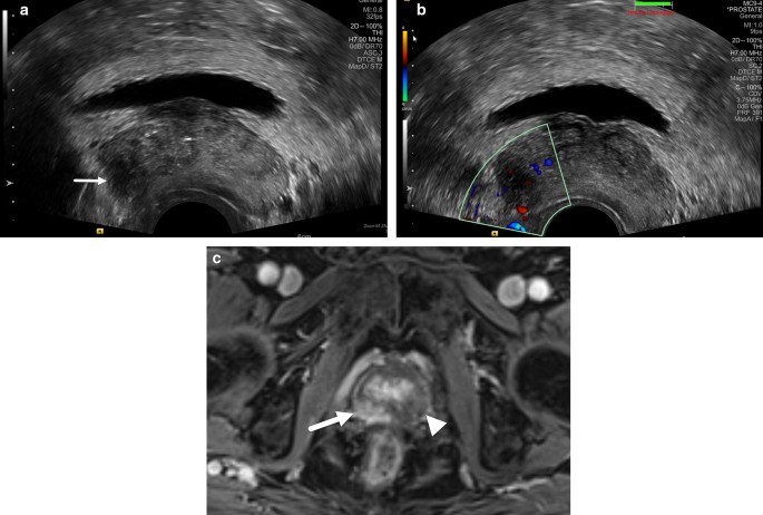 Prostatitis az MRI- n