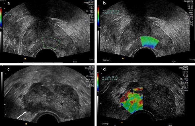 prostate nodule ultrasound