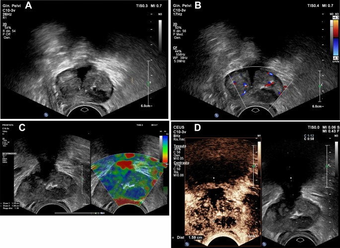 prostate adenoma ultrasound