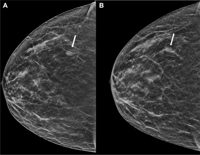 does tirzepatide cause breast cancer Case-Based Review of Breast Imaging Changes Associated With GLP-1 Agonists  | Current Radiology Reports