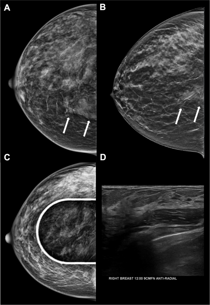 tirzepatide breast pain Case-Based Review of Breast Imaging Changes Associated With GLP-1 Agonists  | Current Radiology Reports