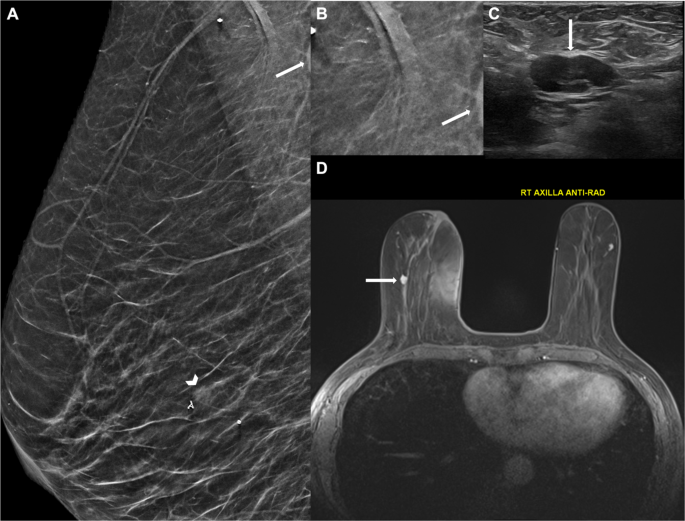 tirzepatide breast pain Case-Based Review of Breast Imaging Changes Associated With GLP-1 Agonists  | Current Radiology Reports