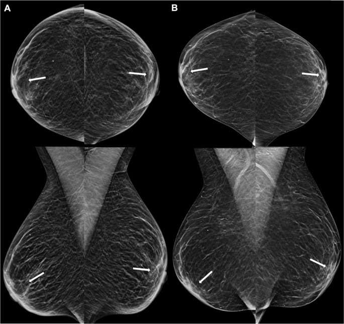 semaglutide breast cancer Case-Based Review of Breast Imaging Changes Associated With GLP-1 Agonists  | Current Radiology Reports
