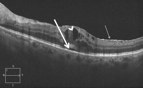 macular oedema oct