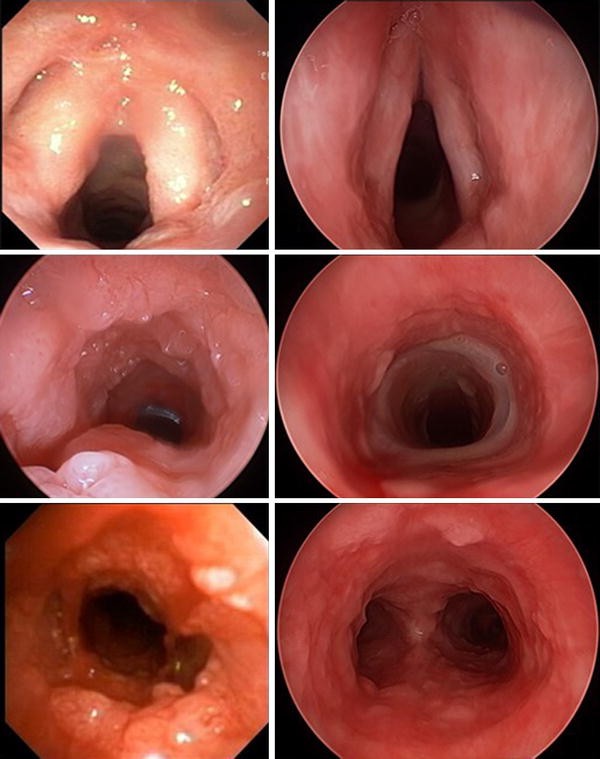 respiratory papillomatosis drug)