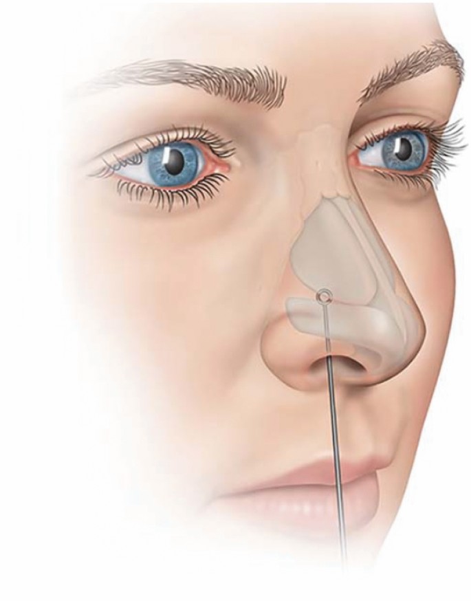 Update on the Evaluation and Management of Nasal Valve Collapse |  SpringerLink