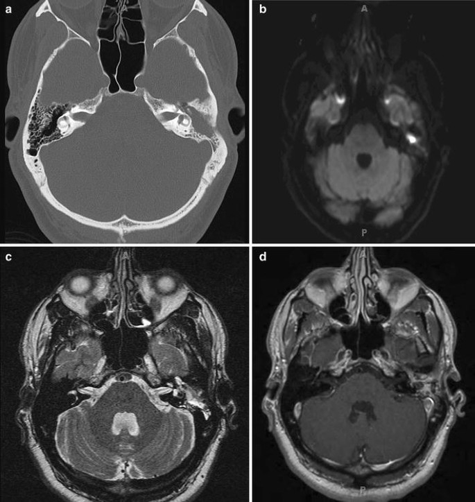 Холестеатома мрт картина