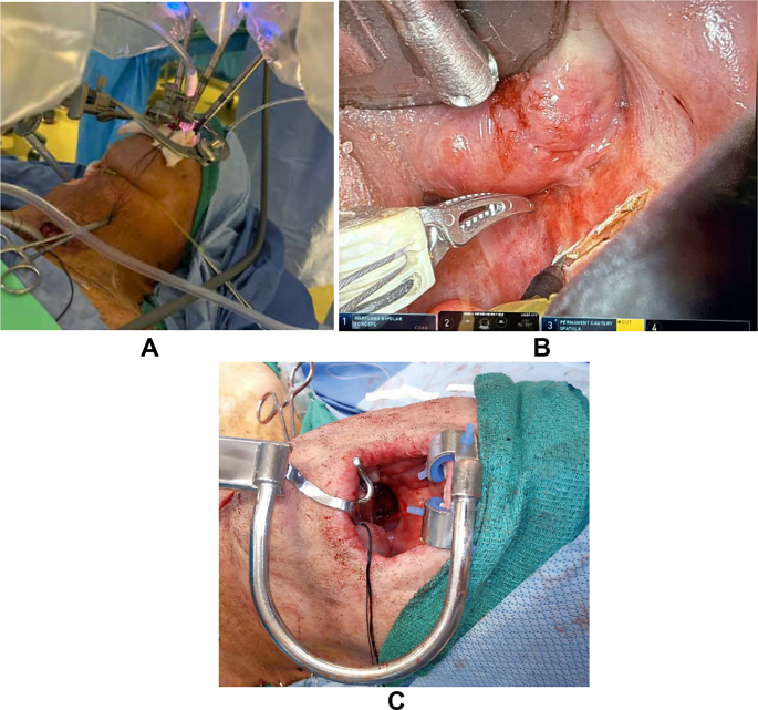 New Innovations in Head and Neck Microsurgical Reconstruction | Current ...