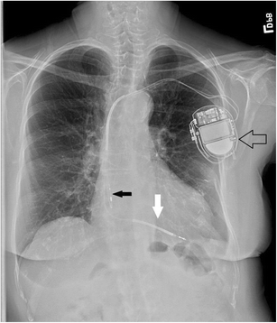 Cardiac Implantable Electric Devices Indications And Complications Springerlink