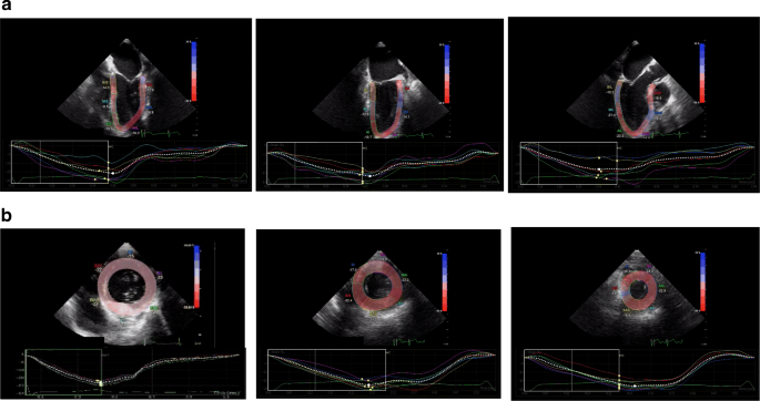 Speckle-Tracking Echo for Assessment of Myocardial Strain: A Case in Images  – Consult QD
