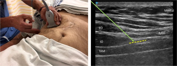 Transversus Abdominis Plane (TAP) and Rectus Sheath Blocks: a Technical  Description and Evidence Review | SpringerLink