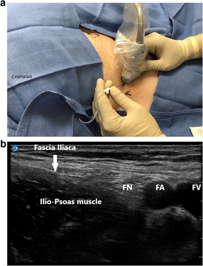 Hospital-, anaesthetist-, and patient-level variation in peripheral nerve  block utilisation for hip fracture surgery: a population-based  cross-sectional study - British Journal of Anaesthesia