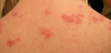 Nursing Paper Example on Cutaneous Lupus Erythematosus
