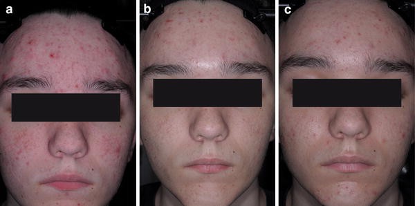 Moderate and Severe Inflammatory Acne Vulgaris Effectively Treated with Single-Agent Therapy by a New Fixed-Dose Combination Adapalene %/Benzoyl Peroxide % Gel: A Randomized, Double-Blind, Parallel-Group, Controlled Study | SpringerLink Moderate and Severe Inflammatory Acne Vulgaris Effectively Treated with Single-Agent Therapy by a New Fixed-Dose Combination Adapalene %/Benzoyl Peroxide % Gel: A Randomized, Double-Blind, Parallel-Group, Controlled Study | SpringerLink