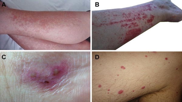 Exercise Induced Vasculitis A Review With Illustrated Cases Springerlink