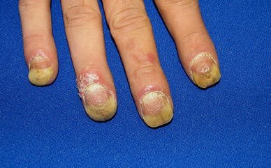 fluocinonide for nail psoriasis)