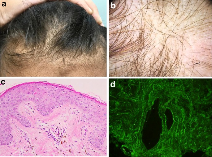 Hair And Scalp Changes In Cutaneous And Systemic Lupus Erythematosus Springerlink