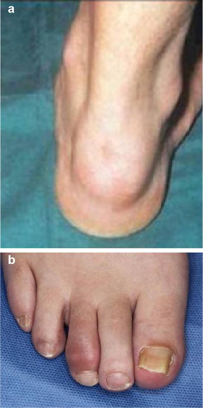 psoriatic arthritis toes