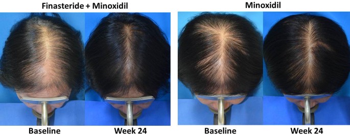 treatment of topical finasteride and minoxidil in hair loss patients after 24 weeks