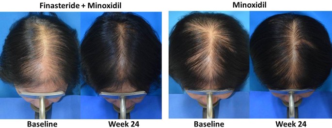 Efficacy of Topical Combination of 0.25% Finasteride and 3% Minoxidil  Versus 3% Minoxidil Solution in Female Pattern Hair Loss: A Randomized,  Double-Blind, Controlled Study | SpringerLink