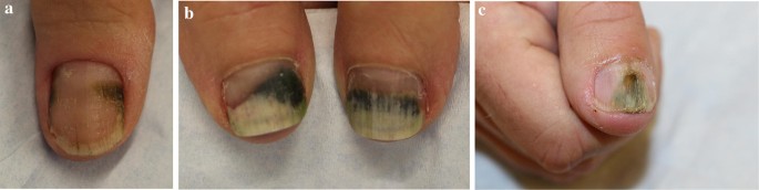 Retrospective Case Series on Risk Factors, Diagnosis and Treatment of Pseudomonas aeruginosa Nail Infections | SpringerLink Retrospective Case Series on Risk Factors, Diagnosis and Treatment of Pseudomonas aeruginosa Nail Infections | SpringerLink