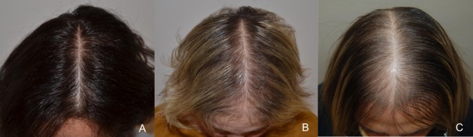 Autologous Skin Microfrafting for Androgenetic Alopecia | Dr Cindy's  Medical Aesthetics
