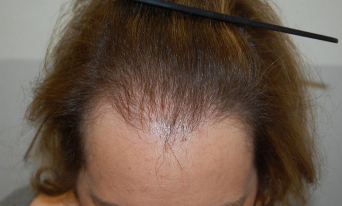 Female Androgenetic Alopecia: An Update on Diagnosis and Management |  SpringerLink