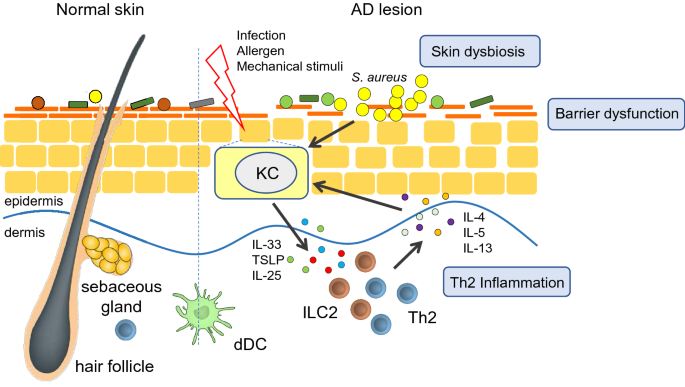 dysbiosis eczema)